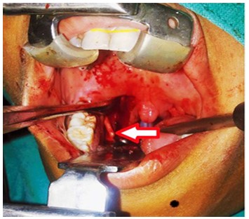 Image Courtesy: Department of ENT, Max Super Speciality Hospital, Shalimar Bagh, New Delhi