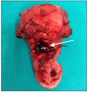 Figure 2: Post-hysterectomy specimen of the uterus, showing CSP tissue by arrow