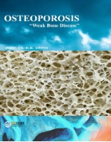 Osteoporosis : Weak Bone Disease
