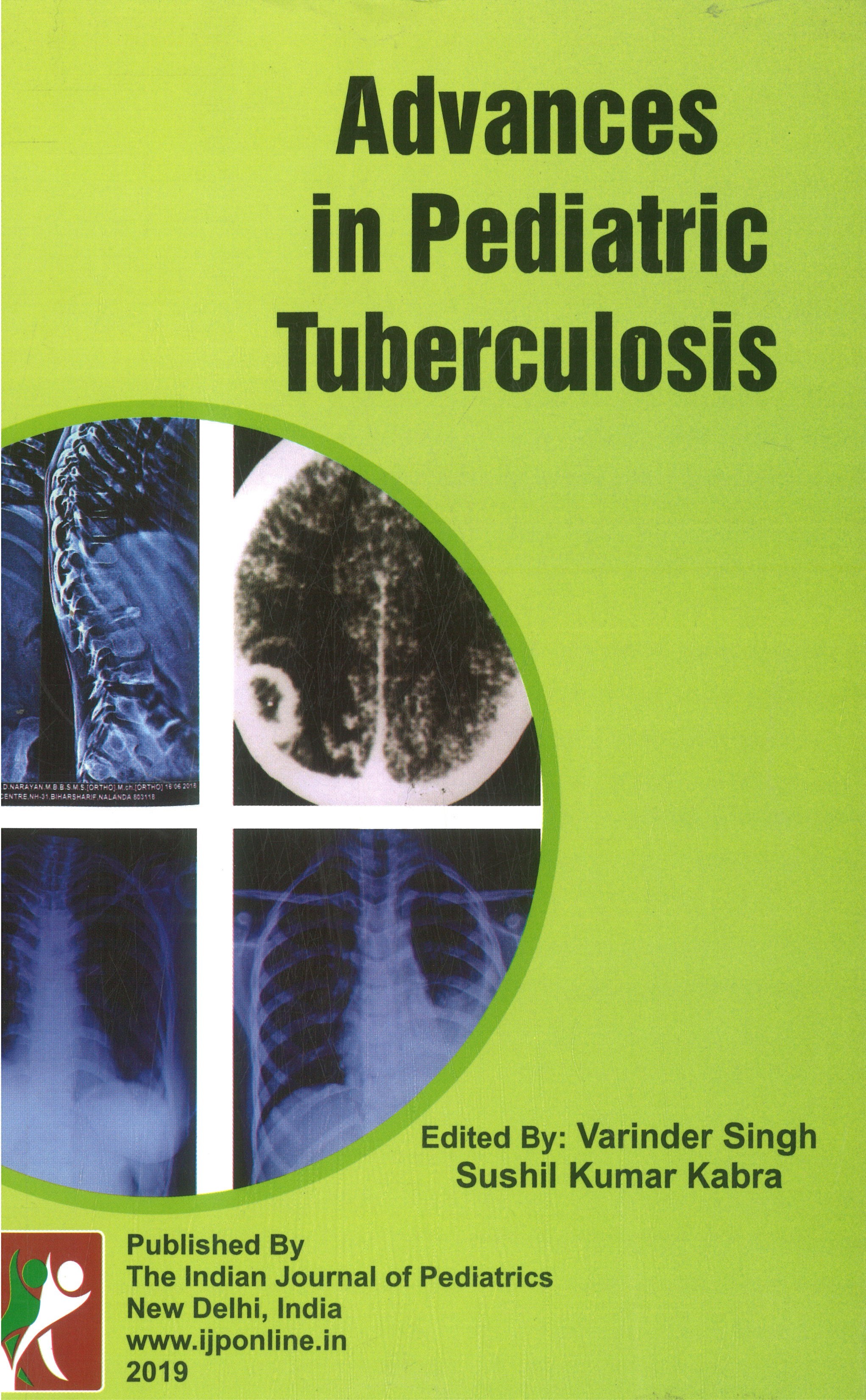 Advnces in Pediatric Tuberculosis